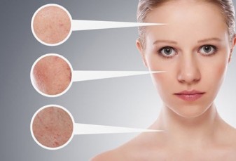 5 Nguyên nhân gây mụn đầu đen và cách phòng ngừa